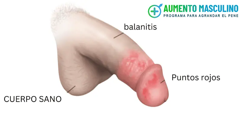 causas de la balanitis